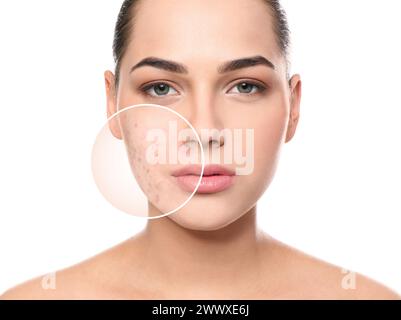 Femme avec de l'acné sur son visage sur fond blanc. Zone agrandie montrant la peau problématique Banque D'Images