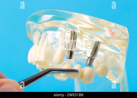 Bridge dentaire dans une pince à épiler sur fond d'un modèle médical de la mâchoire dentaire, gros plan. Prothèse dentaire en orthodontie et odontologie. Mod Banque D'Images