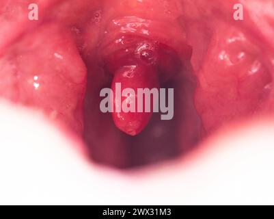 Uvulite et mal de gorge dans la cavité buccale dus à la maladie. Inflammation de la luette et des amygdales due à des infections pendant la maladie, gros plan Banque D'Images