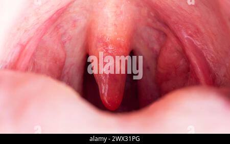 Inflammation de la luette dans la cavité buccale due à une infection et à un virus. Le traitement de la maladie est uvulite. Gorge rouge due à la maladie, macro Banque D'Images