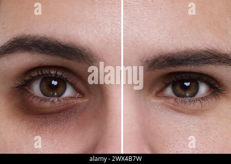 Collage avec des photos de femme avec un cercle sombre sous les yeux avant et après le traitement, gros plan Banque D'Images