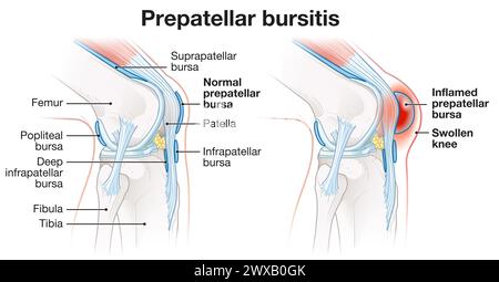 Bursite prépatellaire, inflammation de la bourse séreuse devant la rotule, provoque un gonflement, de la douleur et une sensibilité. Généralement dû à un traumatisme ou à un k répétitif Banque D'Images