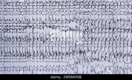 Imagerie de l'enregistrement EEG ictal chez le patient épileptique au cours de la surveillance. Banque D'Images