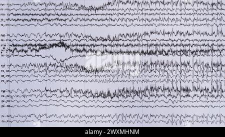 Imagerie de l'enregistrement EEG ictal chez le patient épileptique au cours de la surveillance. Banque D'Images