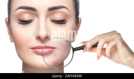 Une femme tient une loupe près du visage et montre la peau à problème. Photo avant et après le traitement de l'acné. Banque D'Images