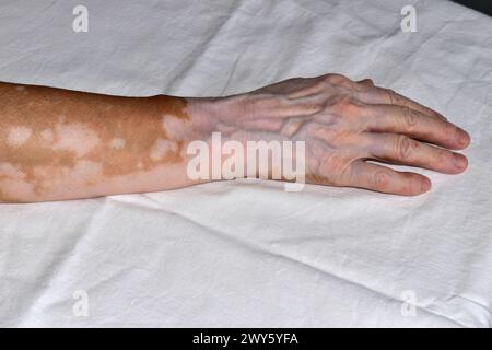 La photo montre un gros plan de la main droite d'une femme âgée, endommagée par la maladie vitiligo, couchée sur blanc. Banque D'Images