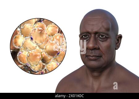 Illustration d'un lipome sur le front d'un homme, et vue rapprochée d'adipocytes, les cellules graisseuses constituant la croissance du lipome. Banque D'Images