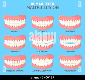 Ensemble de vues de face de différents types de malocclusion dentaire humaine Illustration de Vecteur