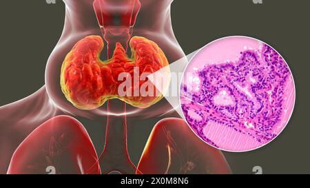 Illustration 3D d'une personne atteinte d'un goitre toxique (hypertrophie de la glande thyroïde, base du cou) et gros plan du tissu thyroïdien affecté. Un goitre est considéré comme toxique lorsque la glande thyroïde élargie produit également une quantité excessive d'hormones thyroïdiennes. Banque D'Images