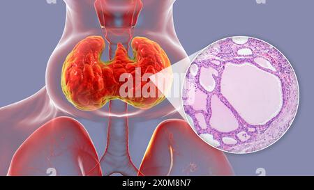 Illustration 3D d'une personne atteinte d'un goitre endémique (hypertrophie de la glande thyroïde, base du cou) et gros plan du tissu thyroïdien affecté. Les goitres endémiques sont causés par un manque d'iode. Elle est considérée comme endémique lorsqu'elle est présente dans plus de 5 % de la population d'une région donnée, ou plus de 10 % de la population scolaire. Banque D'Images