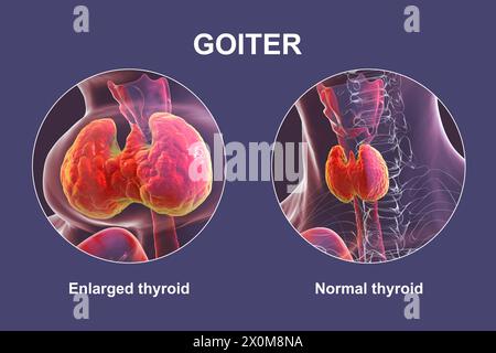 Illustration 3D d'une personne avec une glande thyroïde agrandie (base du cou), connue sous le nom de goitre, et la même personne avec une thyroïde saine (droite) pour comparaison. Banque D'Images