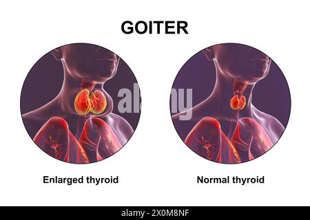 Illustration 3D d'une personne avec une glande thyroïde agrandie (base du cou), connue sous le nom de goitre, et la même personne avec une thyroïde saine (droite) pour comparaison. Banque D'Images