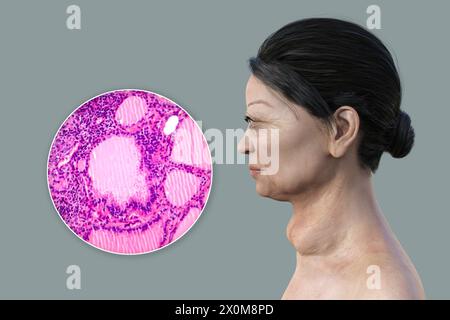 Illustration 3D d'une femme atteinte de la maladie de Basedow et gros plan du tissu thyroïdien affecté. La maladie de Basedow peut provoquer le développement d'une glande thyroïde élargie (goitre, base du cou) et peut provoquer une protrusion anormale des yeux (exophtalmie). La maladie de Basedow est une maladie auto-immune dans laquelle des anticorps sont produits qui provoquent la production excessive d'hormones par la glande thyroïde. Banque D'Images