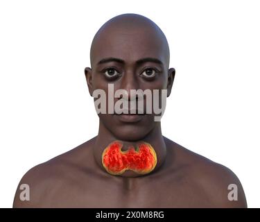 Illustration 3D d'un homme avec une glande thyroïde élargie (goitre, base du cou) et une protrusion anormale des yeux (exophtalmie). Ce sont deux symptômes d'une hyperactivité de la glande thyroïde, connue sous le nom d'hyperthyroïdie. Banque D'Images