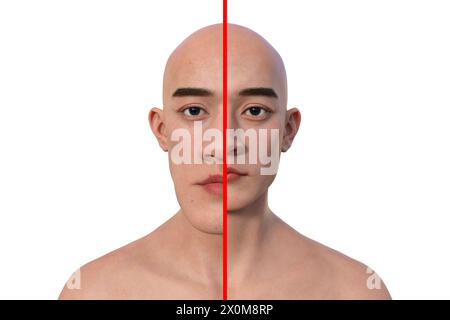 Illustration 3D comparant un homme atteint d'acromégalie (à gauche) et le même homme en bonne santé (à droite). L'acromégalie est une condition provoquant une augmentation de la taille de diverses parties du corps, y compris les traits du visage. Elle est causée par la surproduction de somatotrophine (hormone de croissance humaine) résultant généralement d’une tumeur bénigne (adénome) se formant sur l’hypophyse. Banque D'Images