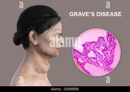 Illustration 3D d'une femme atteinte de la maladie de Basedow et gros plan du tissu thyroïdien affecté. La maladie de Basedow peut provoquer le développement d'une glande thyroïde élargie (goitre, base du cou) et peut provoquer une protrusion anormale des yeux (exophtalmie). La maladie de Basedow est une maladie auto-immune dans laquelle des anticorps sont produits qui provoquent la production excessive d'hormones par la glande thyroïde. Banque D'Images