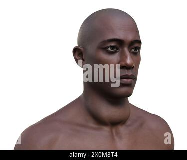 Illustration 3D d'un homme avec une glande thyroïde élargie (base du cou), connue sous le nom de goitre. Banque D'Images