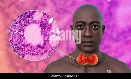 Illustration 3D d'un homme avec une glande thyroïde élargie (goitre, base du cou), et un gros plan du tissu thymus affecté. Banque D'Images