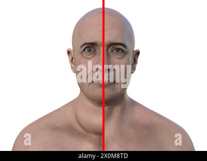 Illustration 3D d'un homme avec une glande thyroïde élargie (goitre, base du cou) et une protrusion anormale des yeux (exophtalmie), et le même homme avec une thyroïde et des yeux sains pour comparaison (à droite). Ce sont deux symptômes d'une hyperactivité de la glande thyroïde, connue sous le nom d'hyperthyroïdie. Banque D'Images