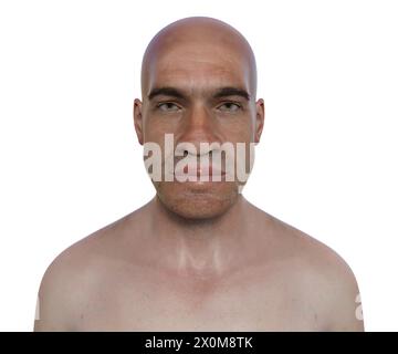 Illustration 3D d'un homme atteint d'acromégalie. C'est une condition provoquant une augmentation de la taille des mains et du visage due à la surproduction de somatotrophine (hormone de croissance humaine). Elle résulte généralement de la formation d'une tumeur bénigne (adénome) sur l'hypophyse. Banque D'Images