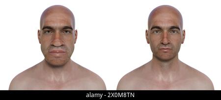 Illustration 3D comparant un homme atteint d'acromégalie (à gauche) et le même homme en bonne santé (à droite). L'acromégalie est une condition provoquant une augmentation de la taille de diverses parties du corps, y compris les traits du visage. Elle est causée par la surproduction de somatotrophine (hormone de croissance humaine) résultant généralement d’une tumeur bénigne (adénome) se formant sur l’hypophyse. Banque D'Images