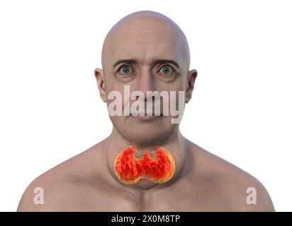 Illustration 3D d'un homme avec une glande thyroïde élargie (goitre, base du cou) et une protrusion anormale des yeux (exophtalmie). Ce sont deux symptômes d'une hyperactivité de la glande thyroïde, connue sous le nom d'hyperthyroïdie. Banque D'Images