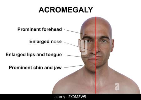 Illustration 3D comparant un homme atteint d'acromégalie (à gauche) et le même homme en bonne santé (à droite). L'acromégalie est une condition provoquant une augmentation de la taille de diverses parties du corps, y compris les traits du visage. Elle est causée par la surproduction de somatotrophine (hormone de croissance humaine) résultant généralement d’une tumeur bénigne (adénome) se formant sur l’hypophyse. Banque D'Images