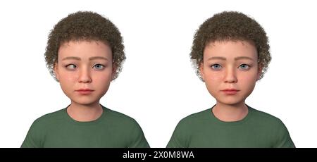 Illustration d'un enfant atteint d'ésotropie montrant un mauvais alignement de l'œil intérieur et le même enfant en bonne santé. Banque D'Images