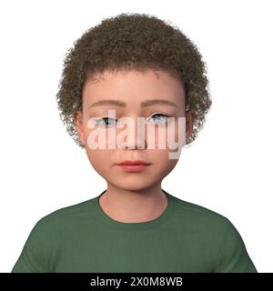 Illustration d'un enfant avec hypotropie montrant un mauvais alignement oculaire vers le bas. Banque D'Images