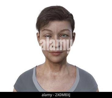 Illustration d'une femme avec hypotropie montrant un mauvais alignement des yeux vers le bas. Banque D'Images