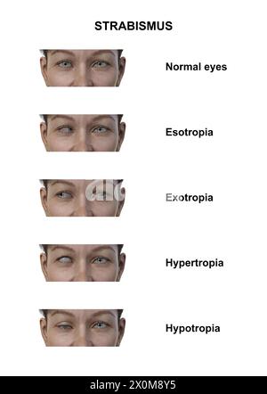 Illustration d'une femme avec divers types de strabisme : ésotropie, exotropie, hypertropie et hypotropie. Banque D'Images