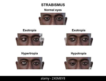 Illustration d'un homme avec différents types de strabisme : ésotropie, exotropie, hypertropie et hypotropie. Banque D'Images