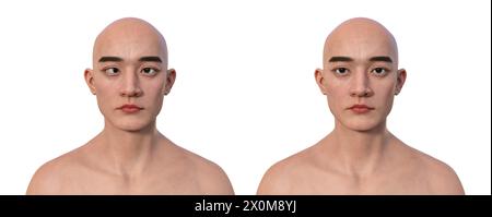 Illustration d'un homme avec l'ésotropie montrant un mauvais alignement de l'oeil vers l'intérieur et le même homme en bonne santé. Banque D'Images