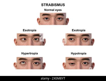 Illustration d'un homme avec différents types de strabisme : ésotropie, exotropie, hypertropie et hypotropie. Banque D'Images