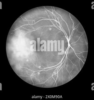 Illustration d'une rétine atteinte de blastomycose vue en angiographie fluorescéinique. Il s’agit d’une infection causée par les champignons Blastomyces dermatitidis. La rétine montre des infiltrats choroïdiens dispersés et une lésion de masse avec fuite de colorant. Banque D'Images