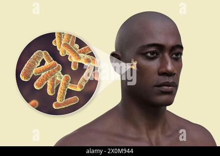 Illustration 3D d'un homme atteint d'une infection bactérienne de l'oreille moyenne (otite moyenne) et gros plan sur les bactéries causales. Les symptômes incluent inflammation, accumulation de liquide et douleur dans l'oreille. Banque D'Images