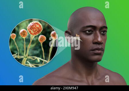 Illustration 3D d'un homme atteint d'une infection de l'oreille moyenne (otite moyenne) et d'un gros plan de champignons, l'un des agents causaux potentiels. Les symptômes incluent inflammation, accumulation de liquide et douleur dans l'oreille. Banque D'Images