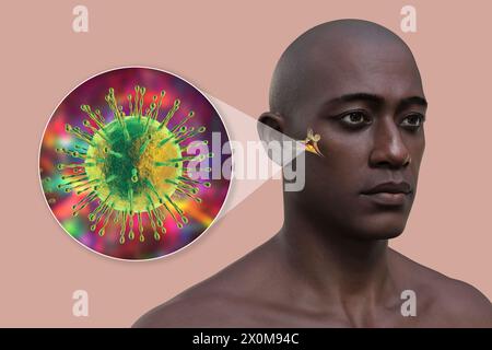 Illustration 3D d'un homme atteint d'une infection virale de l'oreille moyenne (otite moyenne) et d'un gros plan du virus causal. Les symptômes incluent inflammation, accumulation de liquide et douleur dans l'oreille. Banque D'Images