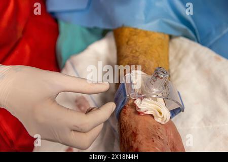 L'infirmière ferme l'accès vasculaire du patient après la chirurgie. Une infirmière applique des bandages vasculaires dans la salle d'opération. Traitement médical à garder Banque D'Images