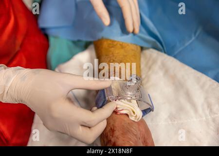 L'infirmière ferme l'accès vasculaire du patient après la chirurgie. Une infirmière applique des bandages vasculaires dans la salle d'opération. Traitement médical à garder Banque D'Images