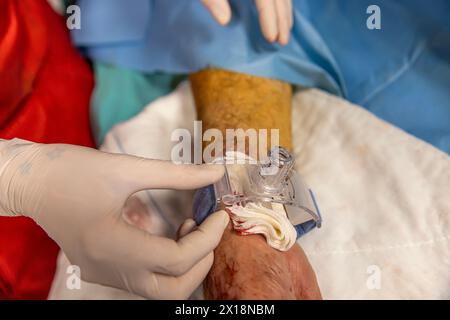 L'infirmière ferme l'accès vasculaire du patient après la chirurgie. Une infirmière applique des bandages vasculaires dans la salle d'opération. Traitement médical à garder Banque D'Images