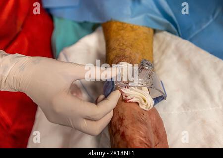 L'infirmière ferme l'accès vasculaire du patient après la chirurgie. Une infirmière applique des bandages vasculaires dans la salle d'opération. Traitement médical à garder Banque D'Images