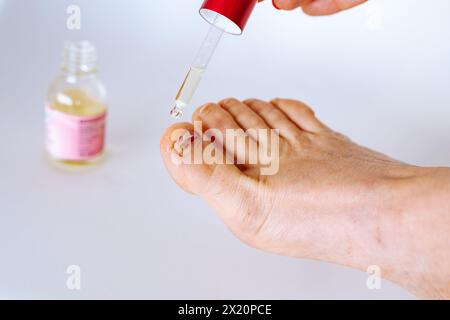 Appliquer de l'huile avec une pipette sur l'ongle endommagé de l'orteil Banque D'Images