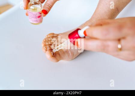 Appliquer de l'huile avec une pipette sur l'ongle endommagé de l'orteil Banque D'Images