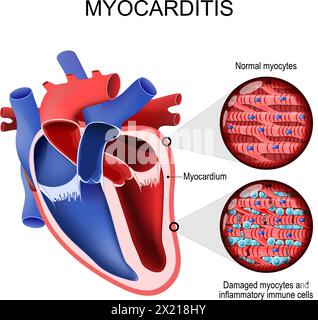 Myocardite. cardiomyopathie inflammatoire. Coupe transversale d'un coeur et d'un myocarde humains. Gros plan d'un myocytes normal, myocytes endommagés et inflammat Illustration de Vecteur