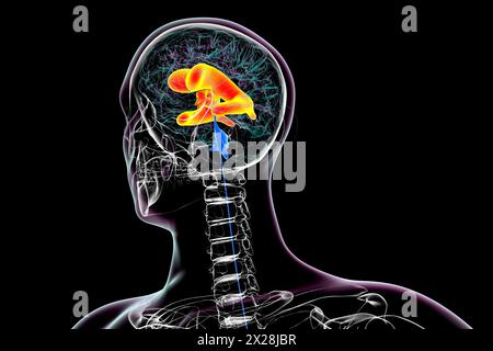 Ventricules latéral et troisième ventricules cérébraux élargis, illustration Banque D'Images