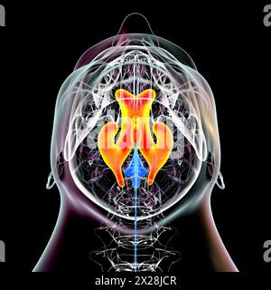 Ventricules latéral et troisième ventricules cérébraux élargis, illustration Banque D'Images