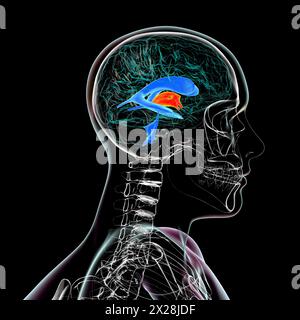 Agrandissement du troisième ventricule cérébral, illustration Banque D'Images