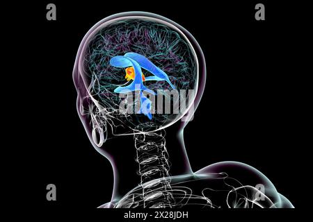 Agrandissement du troisième ventricule cérébral, illustration Banque D'Images