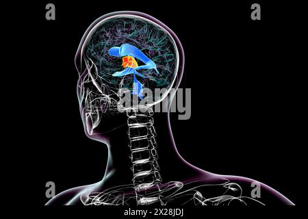 Agrandissement du troisième ventricule cérébral, illustration Banque D'Images